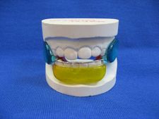 Balter's Bionator - basic type with palatal arch and acrylic discs