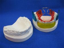 Balter's Bionator - basic type with palatal arch and acrylic discs