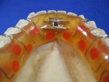 Lower Schwartz plate with Fischer screw