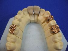 Crown inlay for the tooth 16.