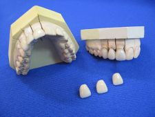 Metal-porcelain crowns for the tooth 11.