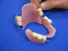 Partial functionally unstable dentures for maxillae and mandible