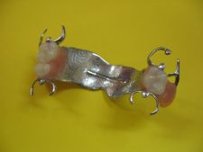 Frame dentures