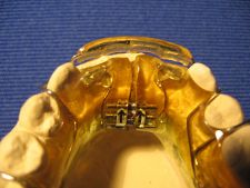 Schwarz lower plate with an acrylic pad of a truss on a labial arch