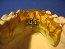 Schwarz lower plate with Fischer screw