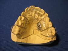 Schwarz plate with Fischer screw for moving a segment with protrusive springs