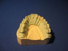 Jacket crowns