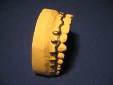 The cast splint after surgical intervention