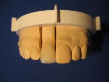 Full-ceramic crown