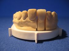 Full-ceramic crown